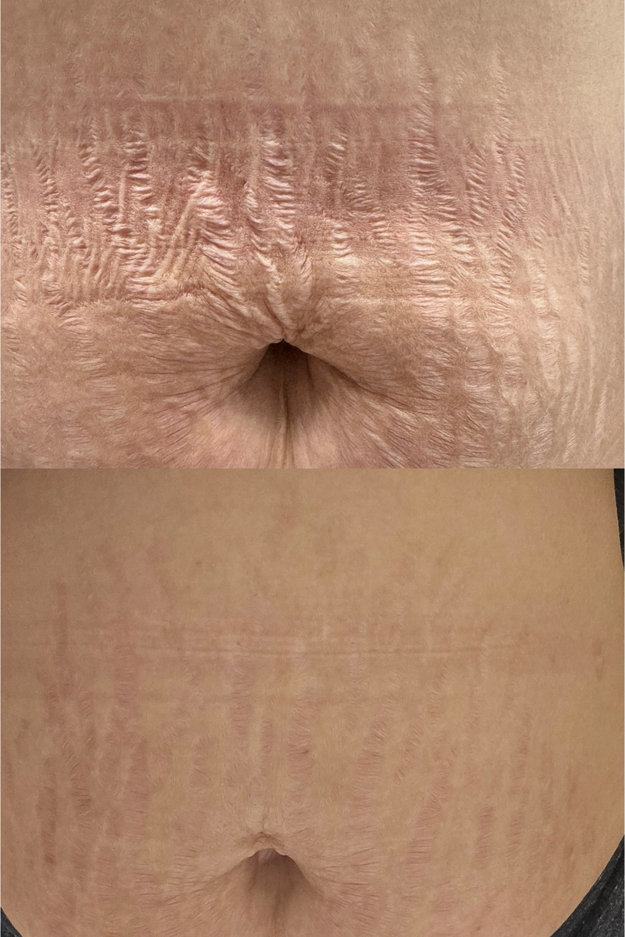 Stretch mark revision result